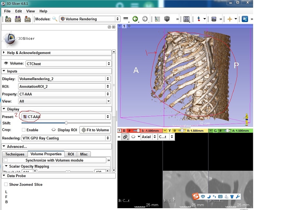 用volume 预设直接生成的三维图像能不能保存成model? - 3DSlicer | 课程答疑 - 3DSlicer龙虾社区