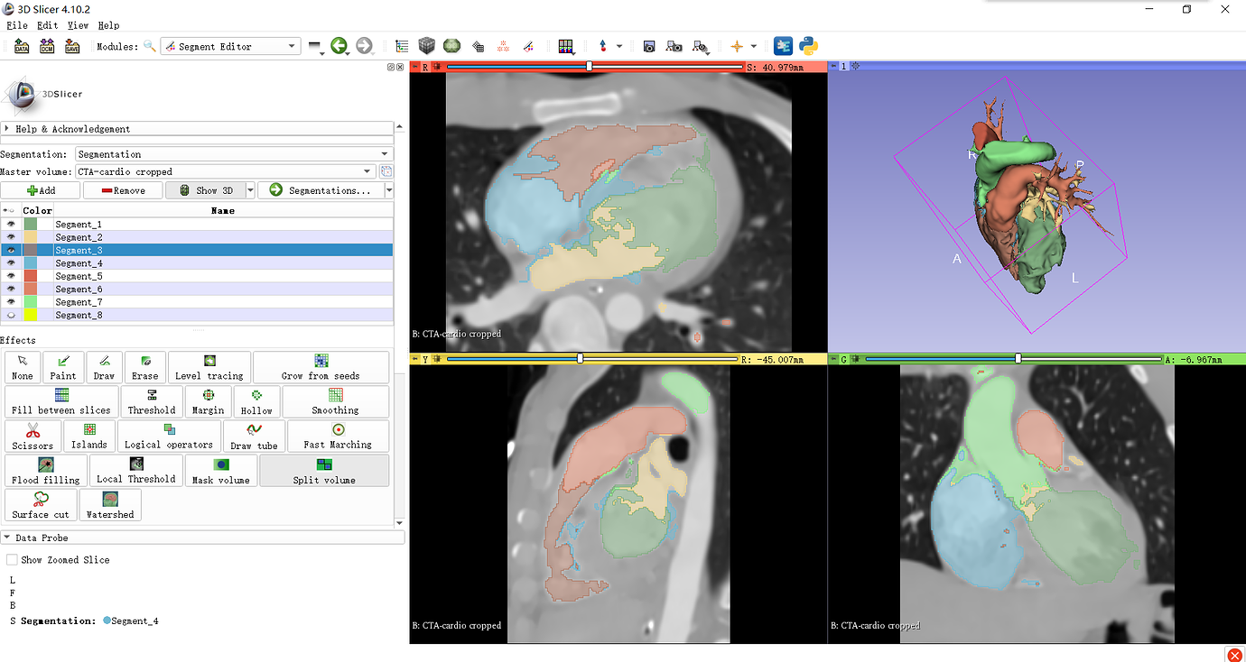 Segment editor split volume 3dslicer 