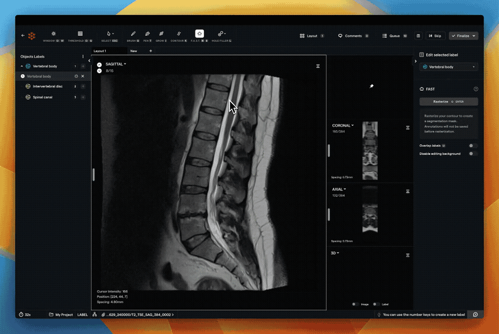 Ai meta ai s segment anything for medical imaging 